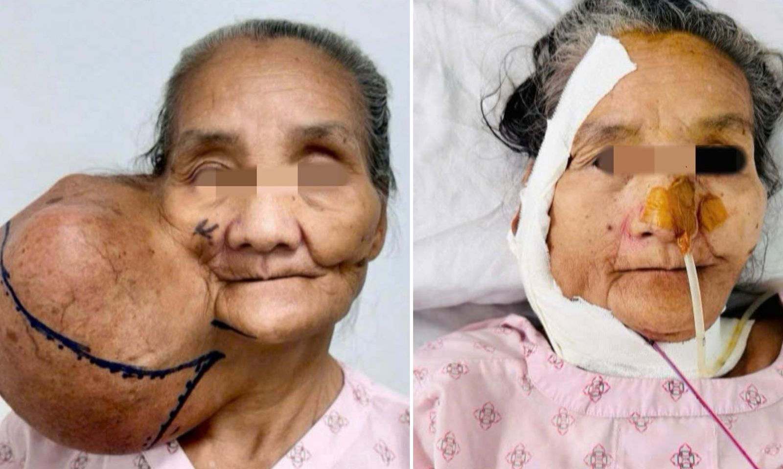 Loại bỏ khối u khổng lồ hơn 40 năm ‘bám’ trên khuôn mặt cụ bà dân tộc thiểu số