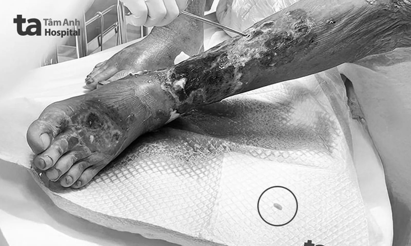 Bị côn trùng đốt khi đi rừng, người đàn ông không ngờ bị giòi làm tổ trong chân