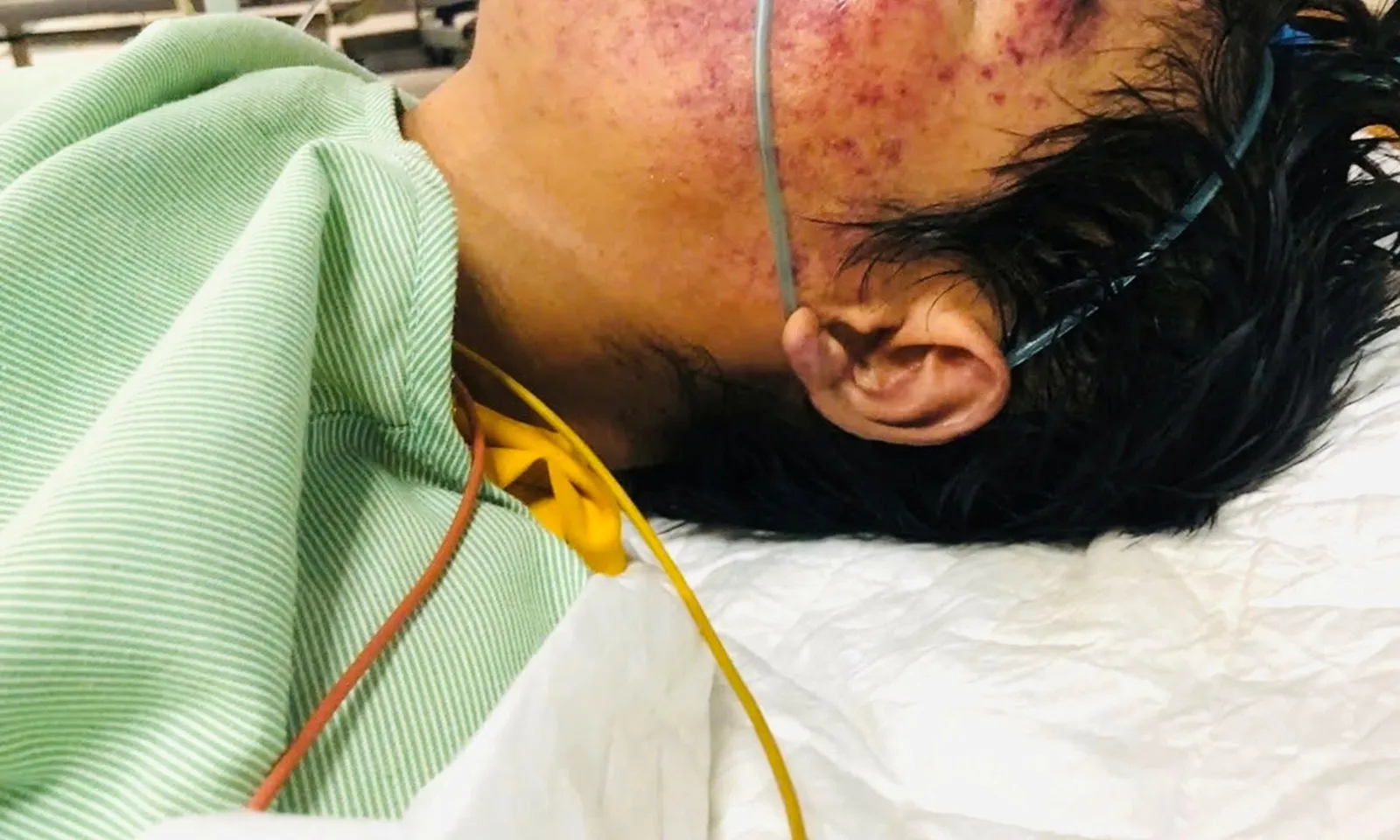 Người đàn ông suy đa tạng nguy kịch do ăn tiết canh nhiễm liên cầu heo