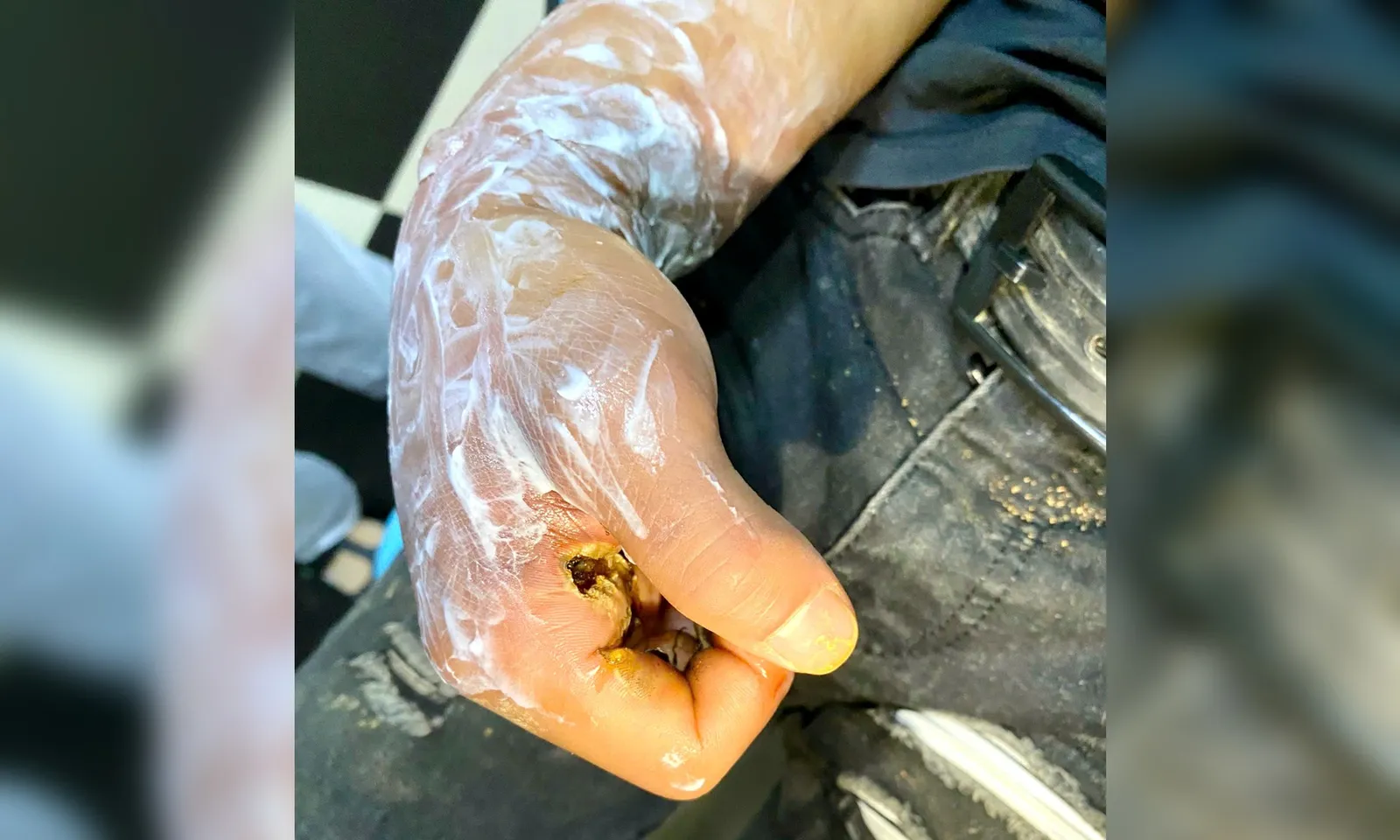 Người đàn ông có nguy cơ bị cắt cụt cẳng tay do điện giật khi câu cá