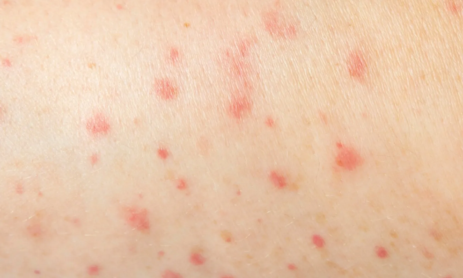 Tái phát bệnh zona nhiều lần làm tăng nguy cơ mắc chứng mất trí nhớ