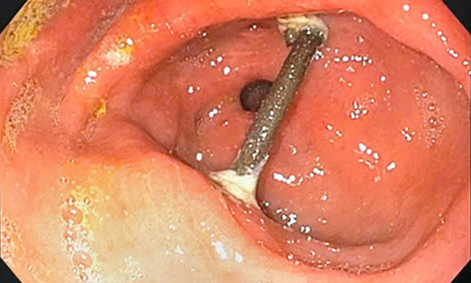 Uống thuốc lá tự sắc, người đàn ông nuốt phải cành cây dẫn tới thủng dạ dày