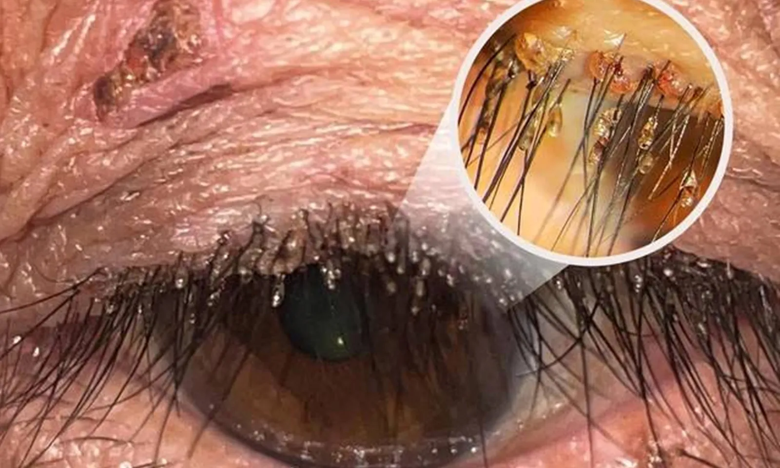 Ngứa mi mắt dai dẳng, bệnh nhân bất ngờ phát hiện bị rận mu “lạc chỗ”