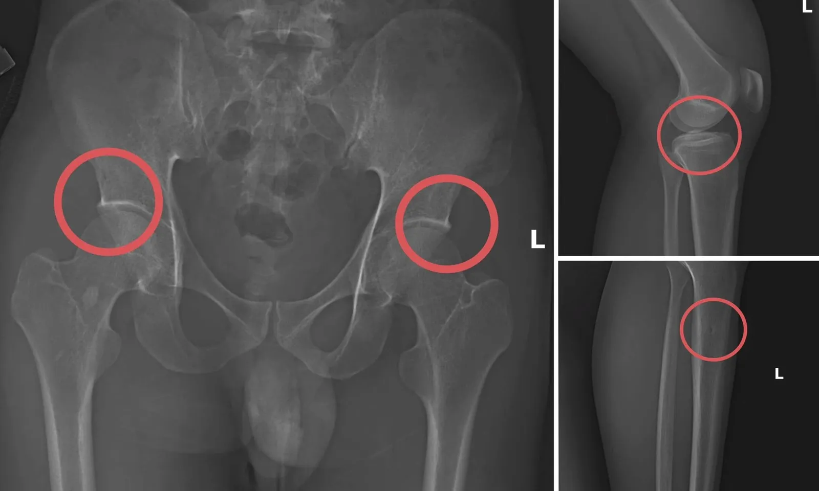 Phá đường dây tự đục vỡ xương khớp nhằm chiếm đoạt hàng tỷ đồng tiền bảo hiểm nhân thọ