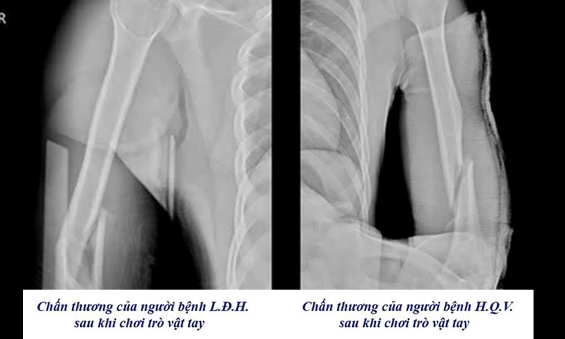 3 người gãy tay vì chơi “vật tay” trong vòng một tuần