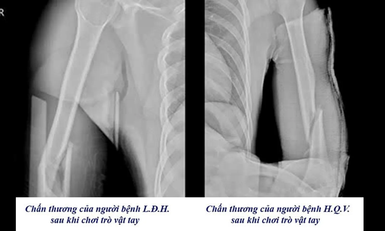 3 người gãy tay vì chơi “vật tay” trong vòng một tuần