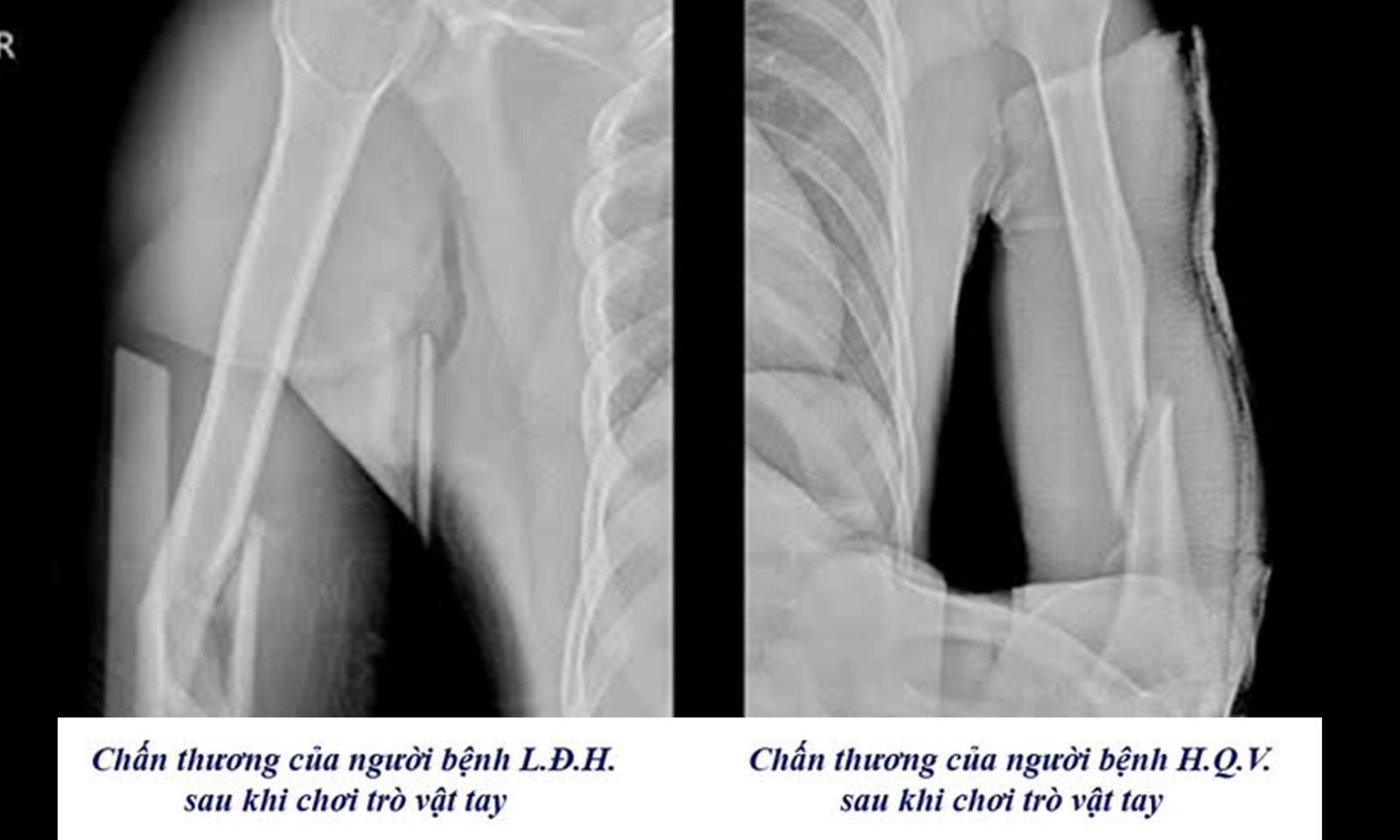 3 người gãy tay vì chơi “vật tay” trong vòng một tuần
