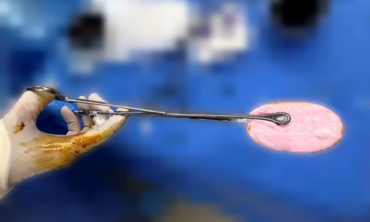 Bé gái 12 tuổi phải cấp cứu vì nhét xà bông vào vùng kín