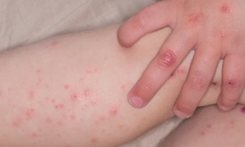 TPHCM cảnh báo EV71 gây tay chân miệng nặng