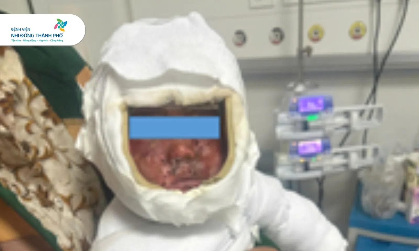 Bé trai 9 tháng tuổi bỏng 30% cơ thể do kéo dây nguồn ấm siêu tốc