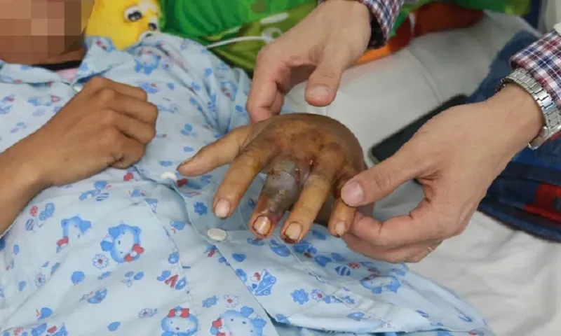 Tự đắp lá chữa rắn cắn, nam thanh niên bị nhiễm độc nặng