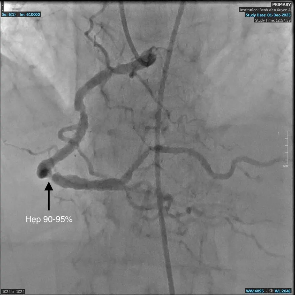 Mạch máu trước can thiệp hẹp đến 95%