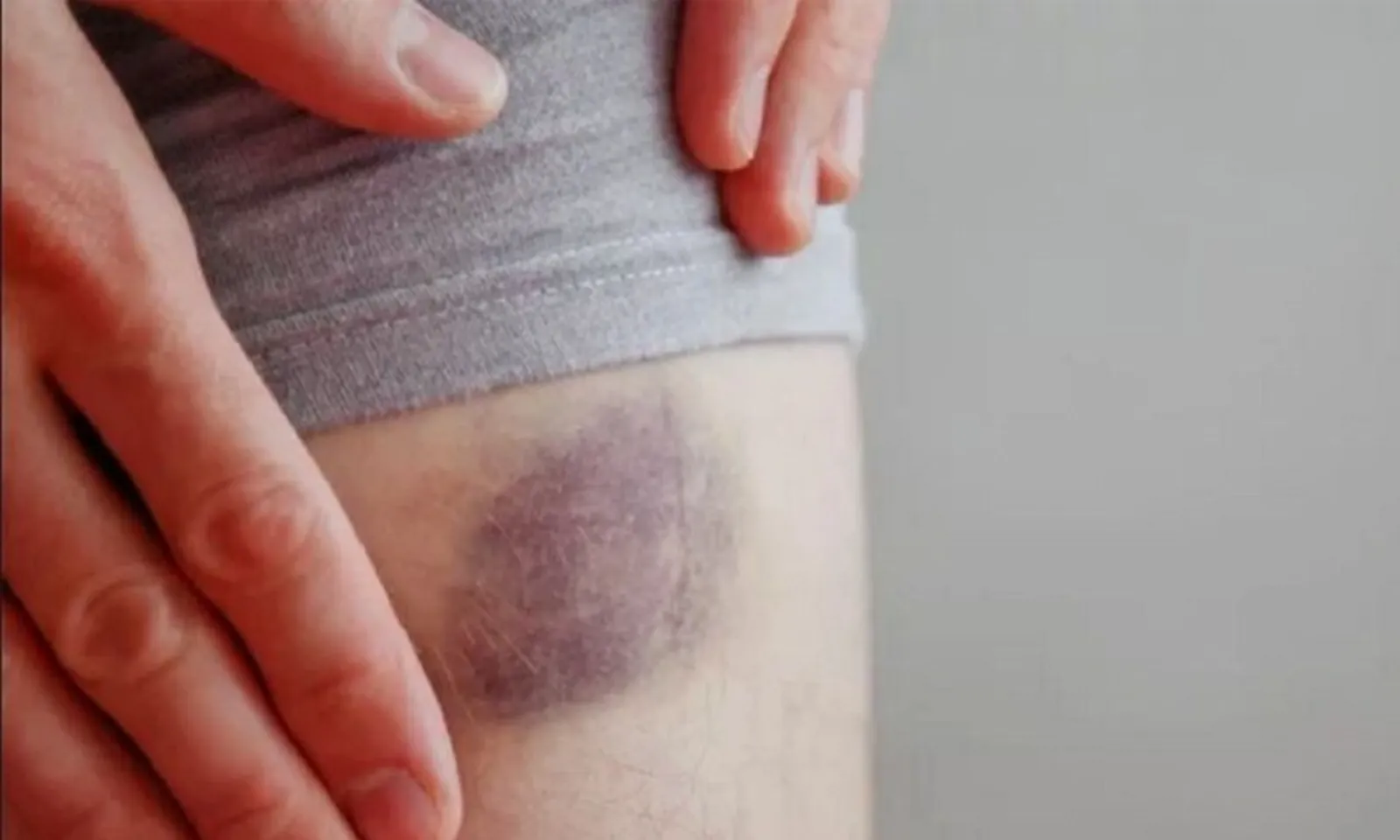 Những cách làm tan máu bầm hiệu quả tại nhà – Hình 1