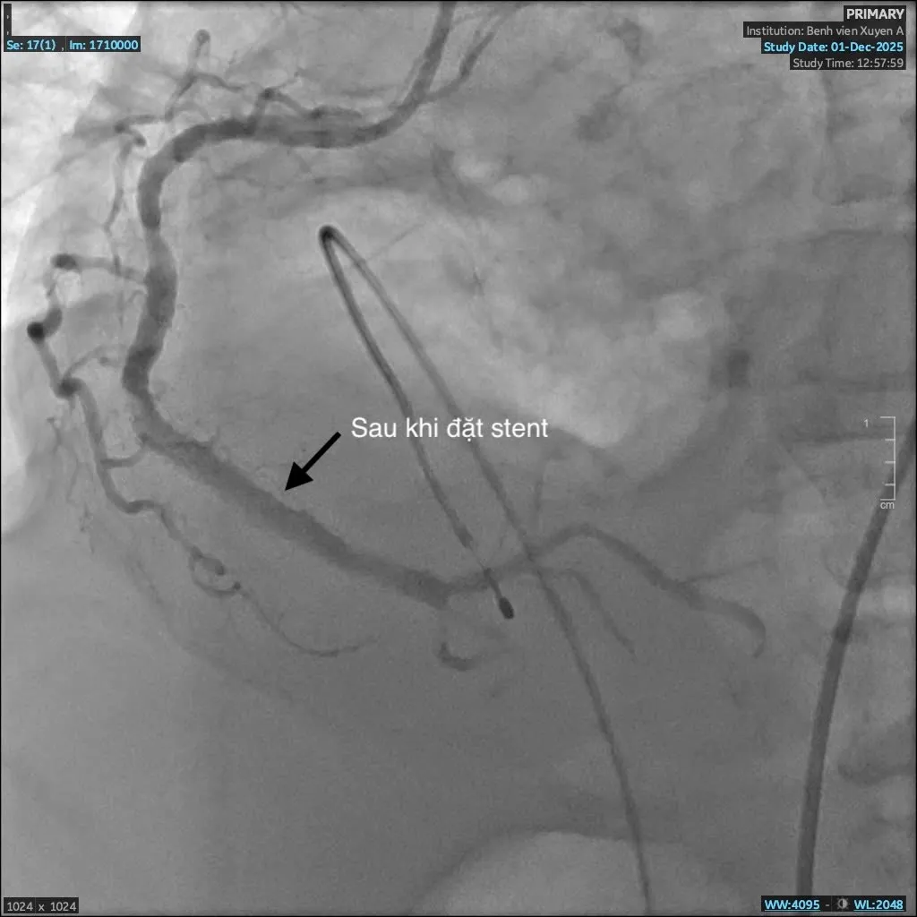 Sau can thiệp stent, tái thông được mạch máu