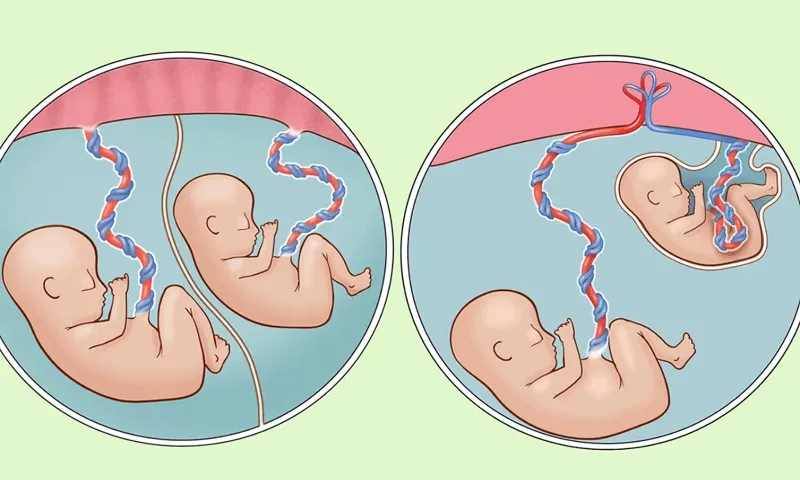 Cứu sống bé trai sinh non nặng chưa tới 1kg