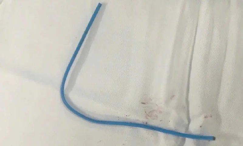 Can thiệp nội mạch lấy ống thông truyền hóa chất mắc kẹt trong tim bệnh nhân