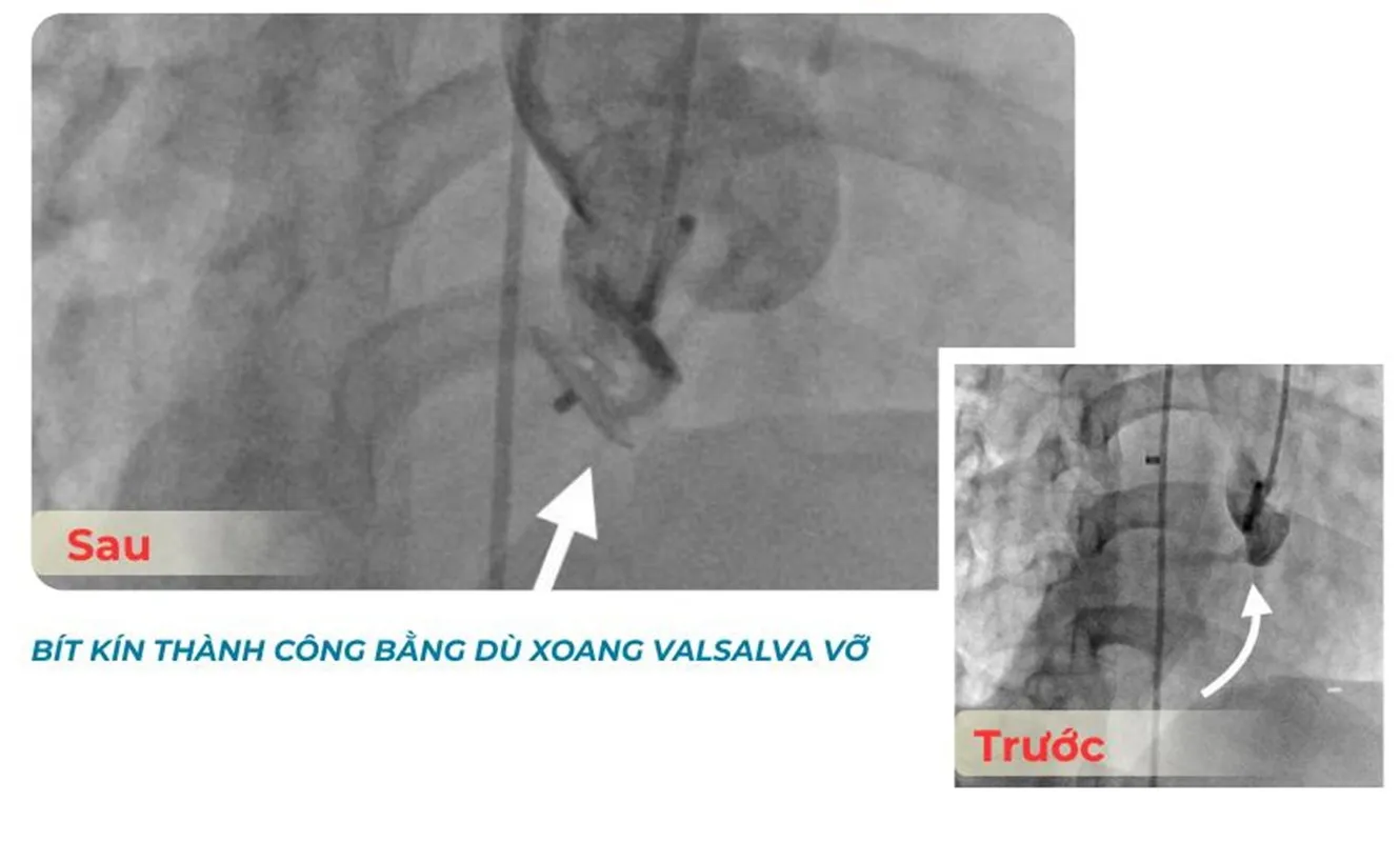 Cấp cứu thành công ca bệnh tim hiếm gặp chỉ chiếm 0,09% dân số