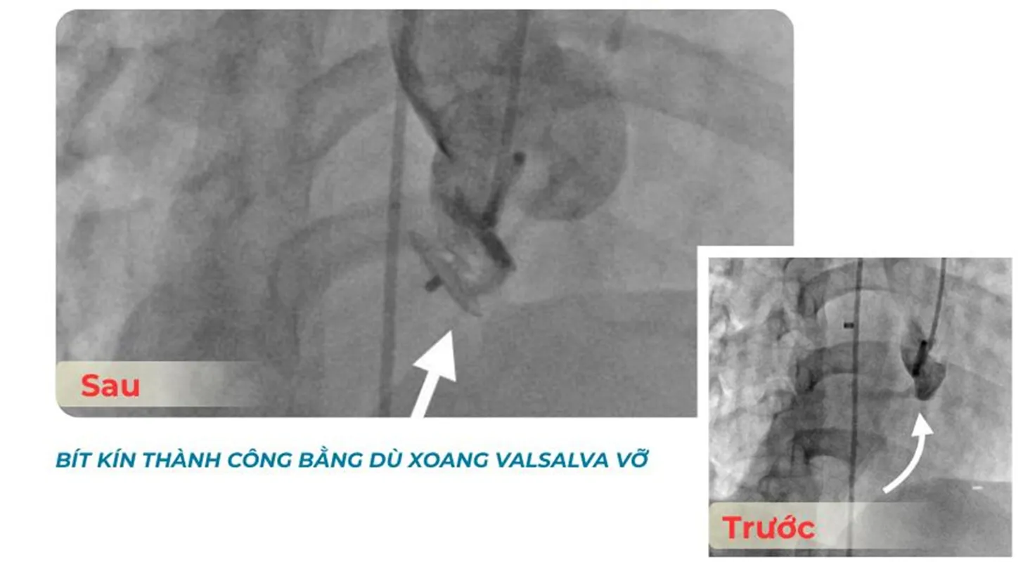Bít kín thành công bằng dù xoang Valsalva vỡ. Ảnh Bệnh viện