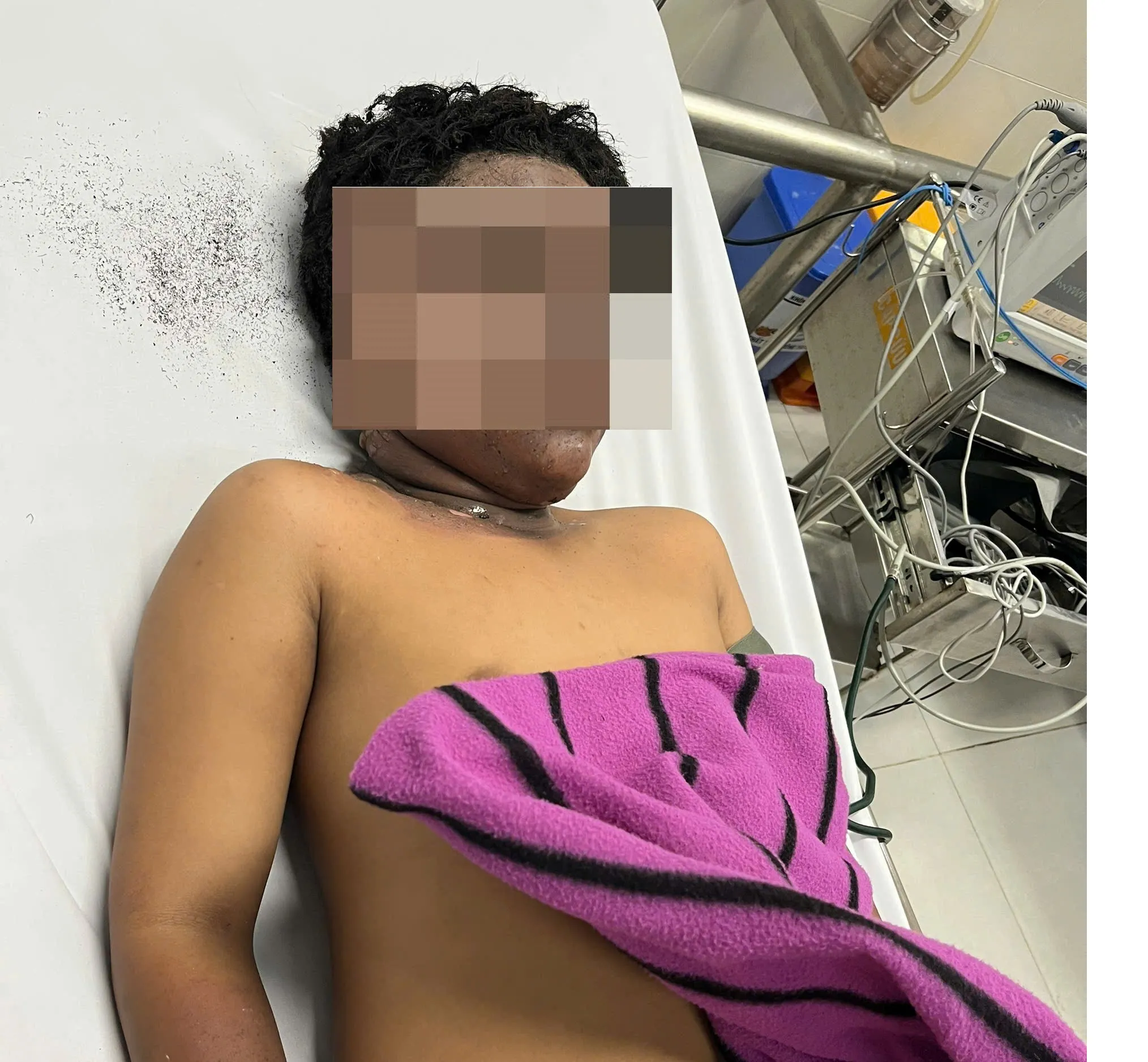 Bỏng pháo nặng vùng mặt