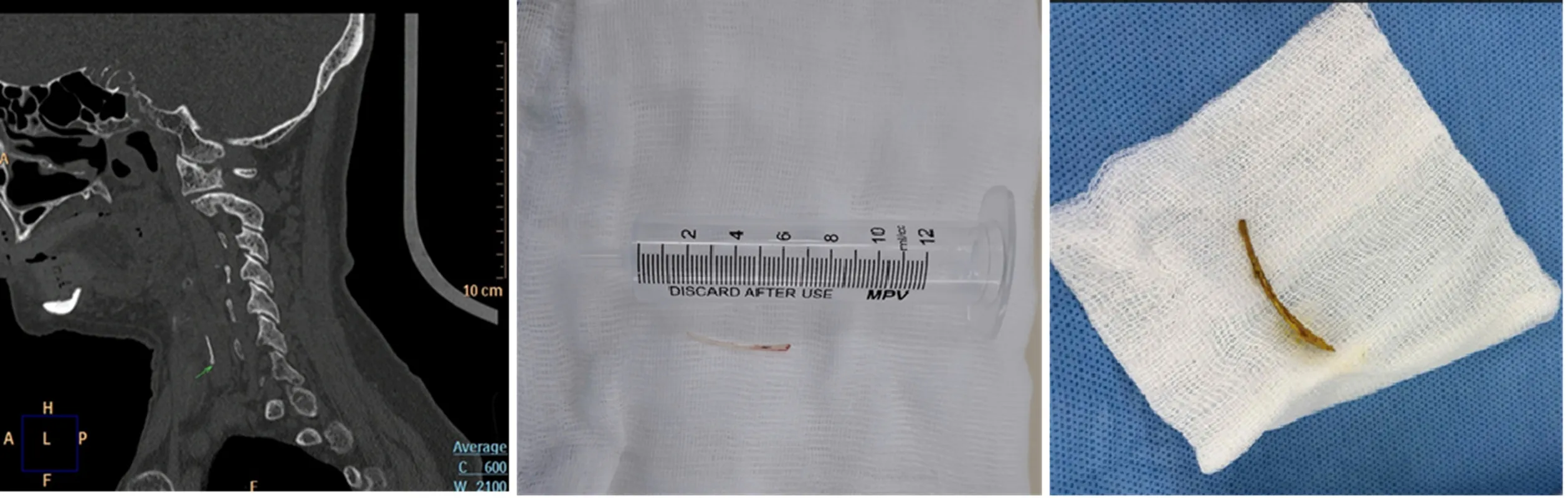 Mắc xương cá rất gặp phải trong đời sống