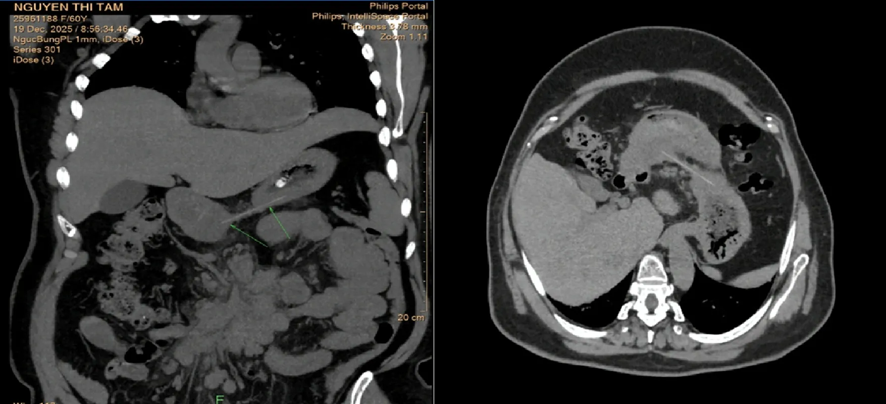 Một cây tăm dài 6cm trong bụng bệnh nhân