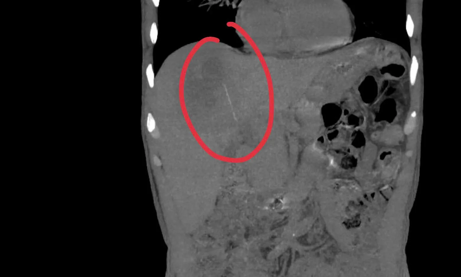 Từ thói quen thường ngày, dẫn đến đối mặt biến chứng nguy hiểm