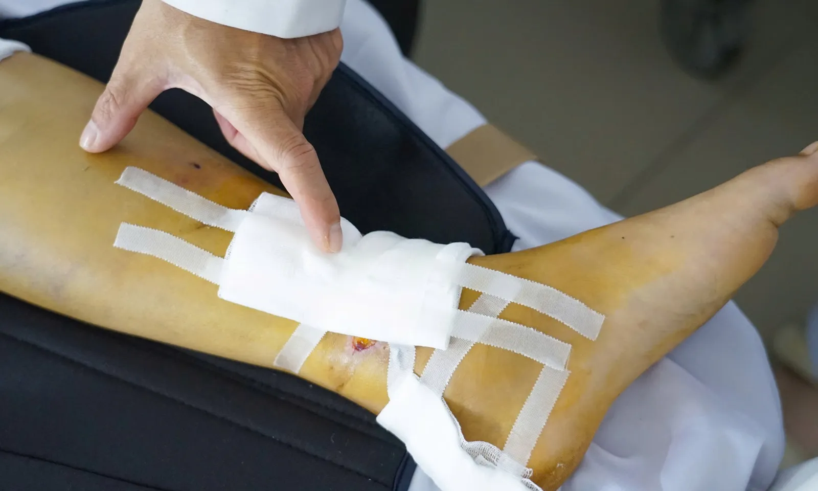 Phẫu thuật thành công ca đa chấn thương gãy ổ cối phức tạp