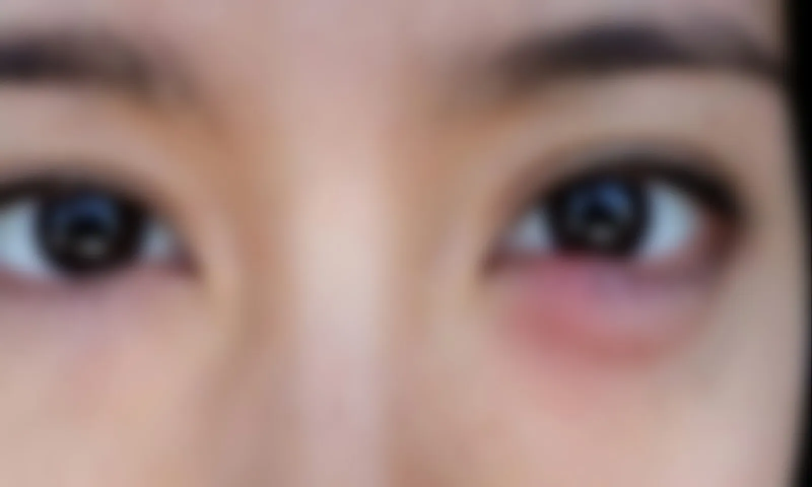 Những cách giảm sưng mắt đơn giản, hiệu quả tại nhà – Hình 1