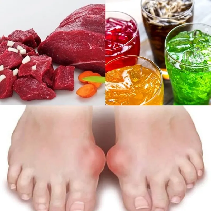 Khi mắc phải căn bệnh gout thì chế độ ăn uống là điều vô cùng quan trọng. Ảnh minh họa