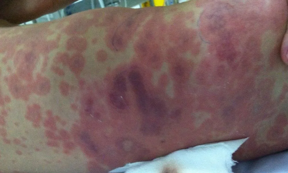 Cảnh báo nguy cơ lây lan viêm màng não mô cầu, yêu cầu giám sát chặt