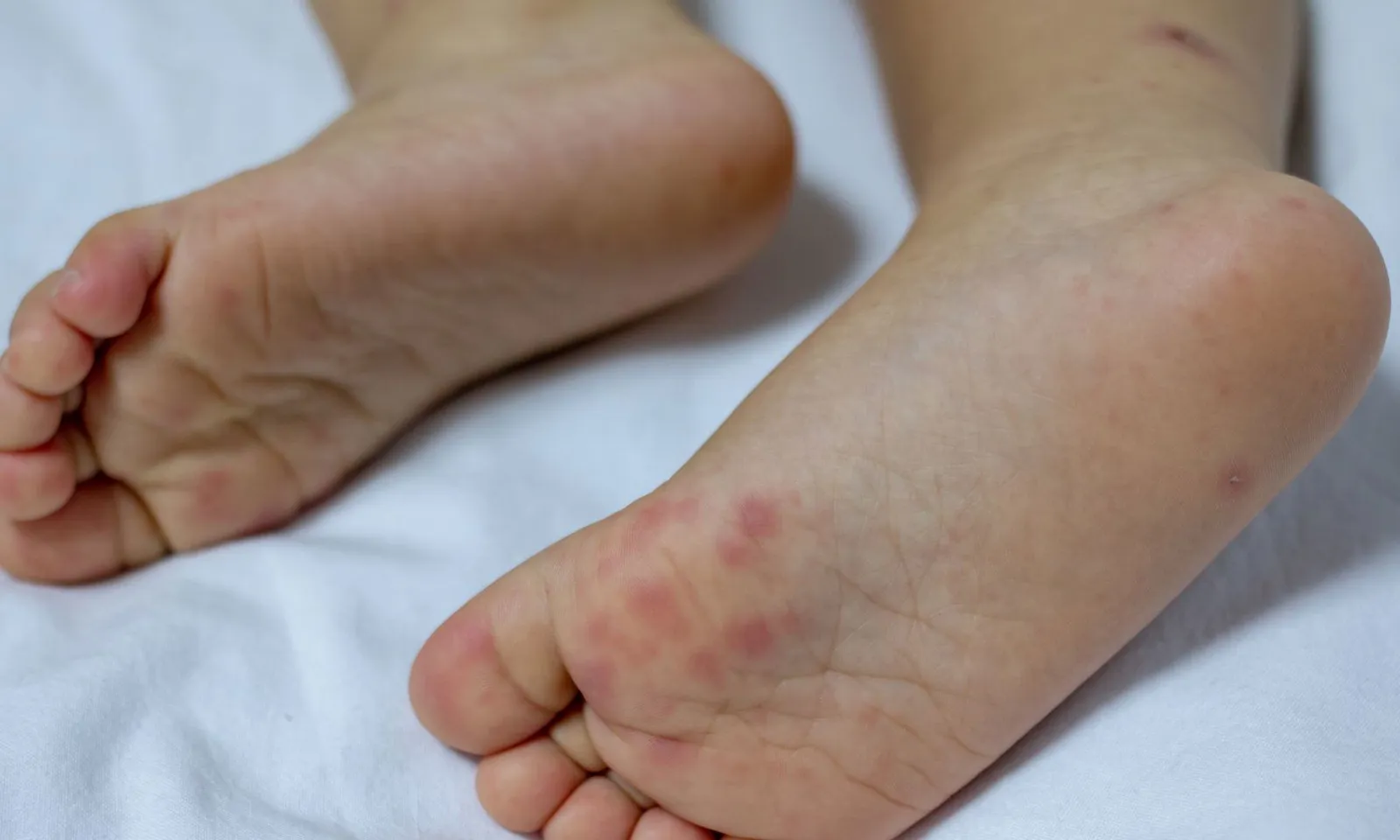 3 tháng, hơn 25.000 ca mắc tay chân miệng, tăng gấp 5 lần