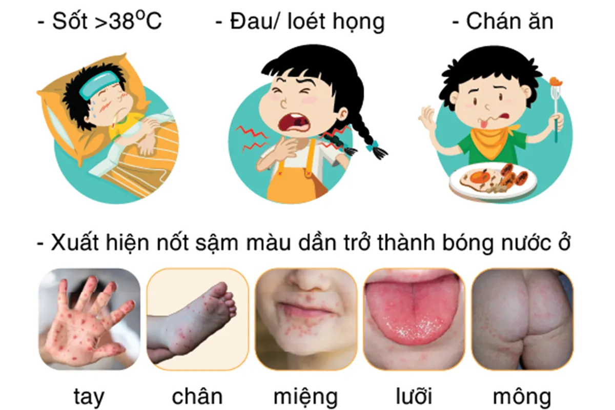 Biểu hiện tay chân miệng