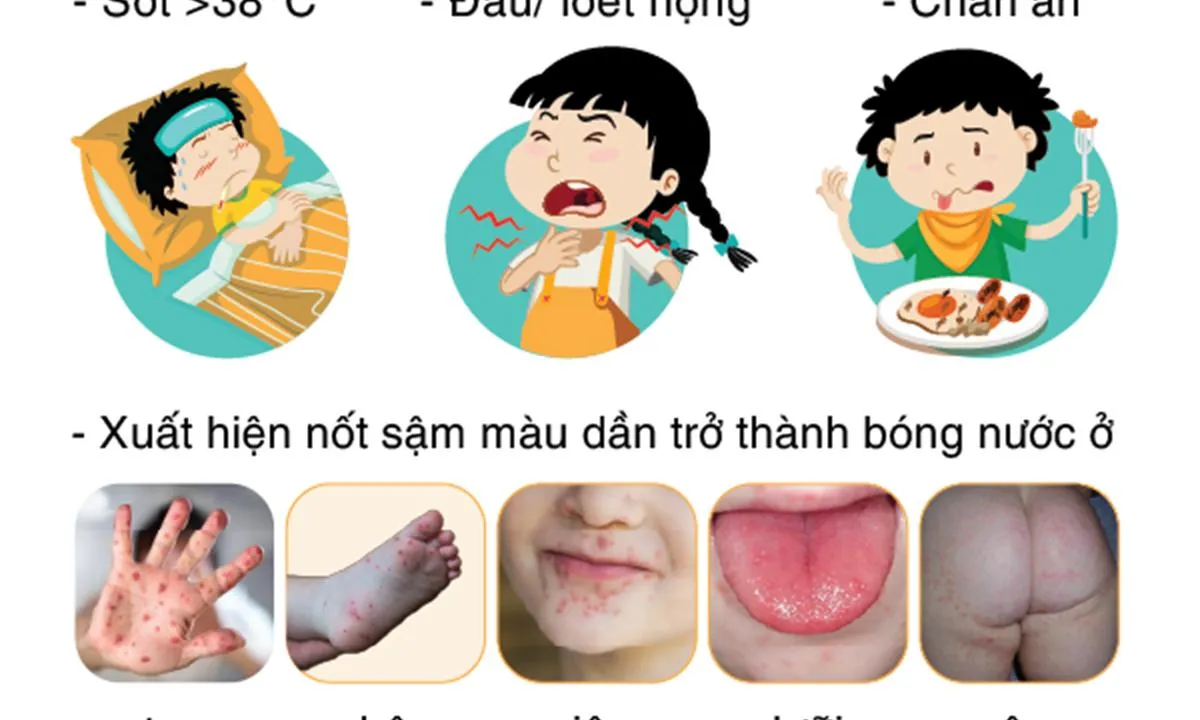 Ca tay chân miệng tại TPHCM tăng vọt, xuất hiện chủng virus nguy hiểm EV71