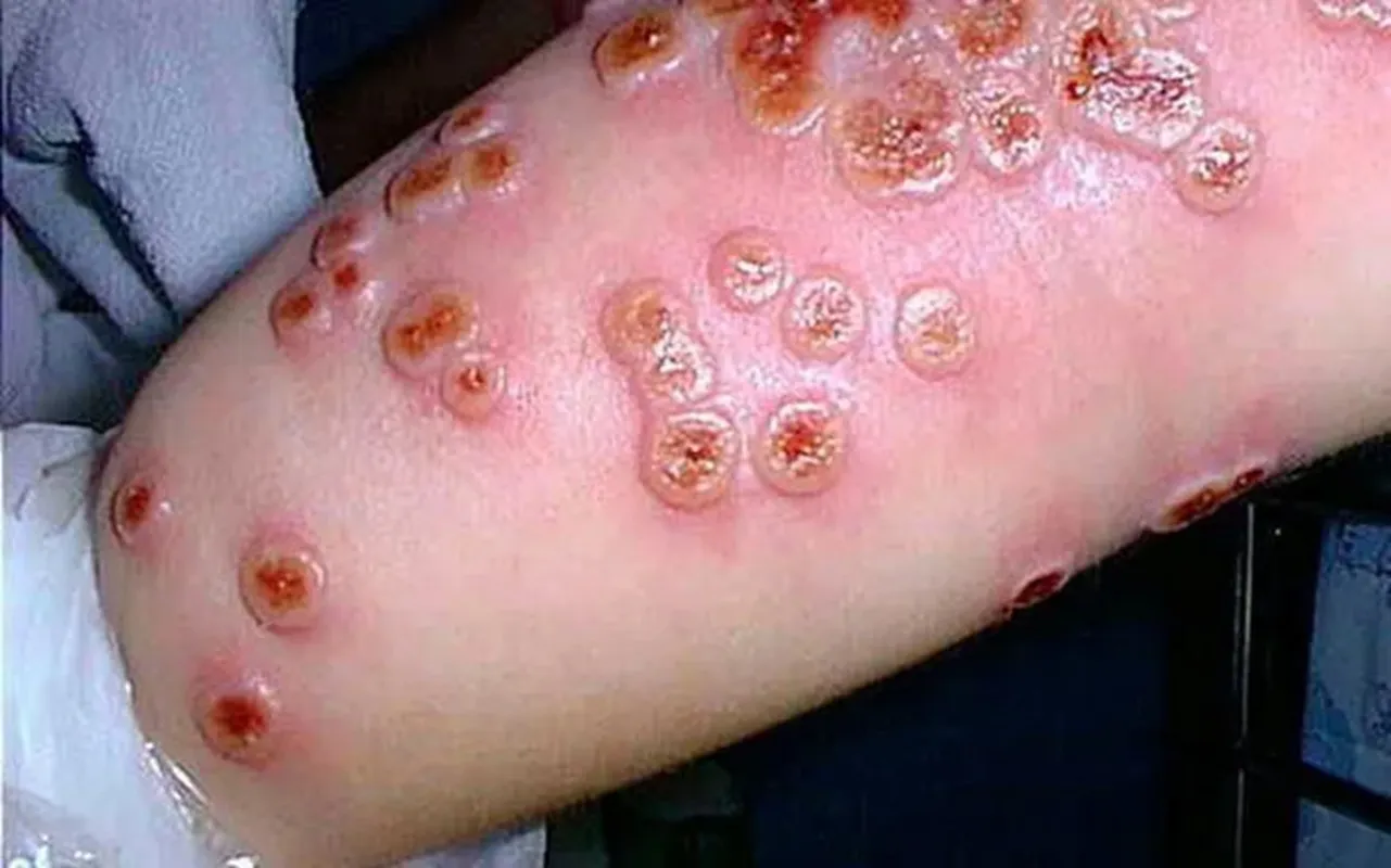 Tổn thương ở bệnh đậu mùa. Hình minh họa