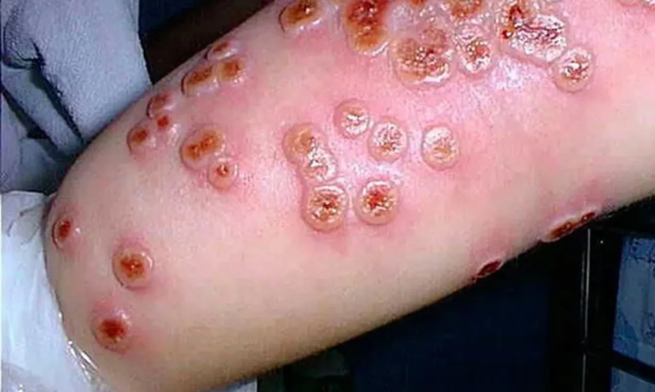 Singapore phát hiện biến thể đậu mùa khỉ nguy hiểm