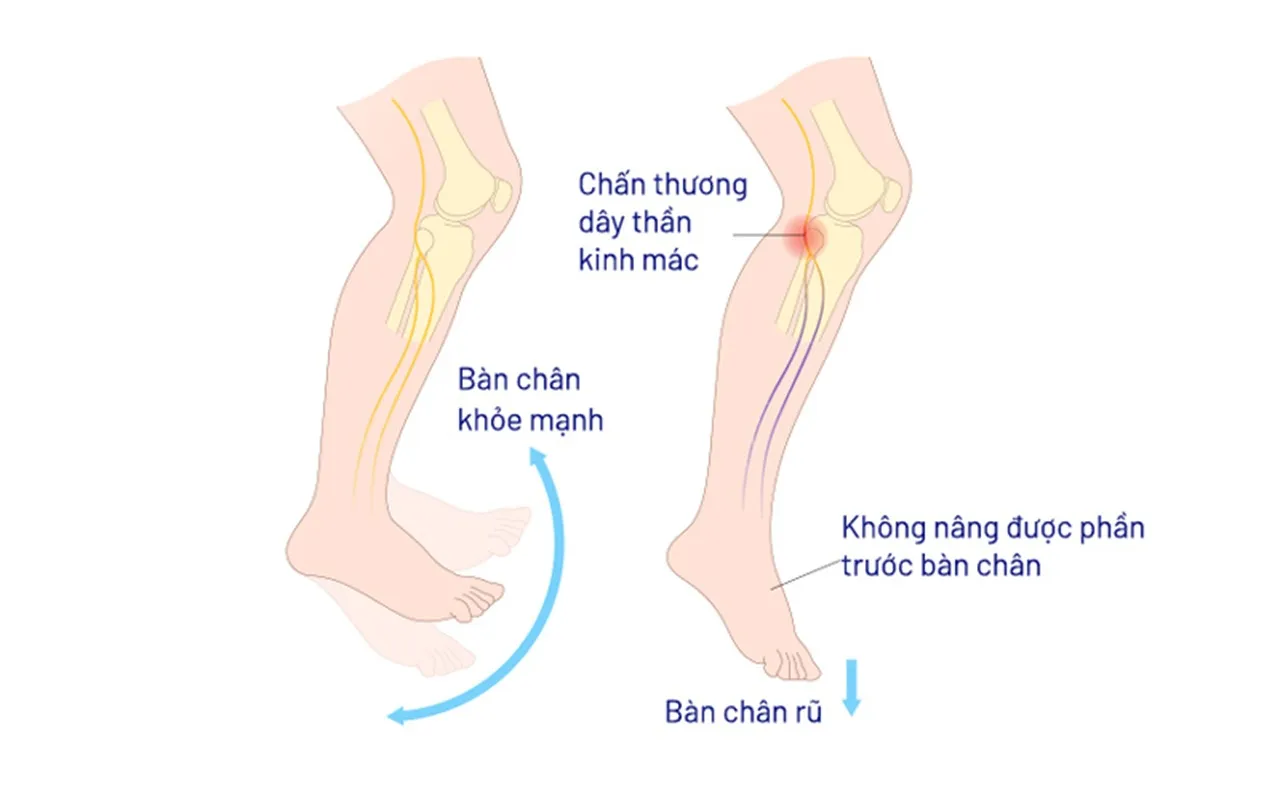 Tình trạng bàn chân rũ gây nhiều khó khăn trong việc di chuyển của người bệnh