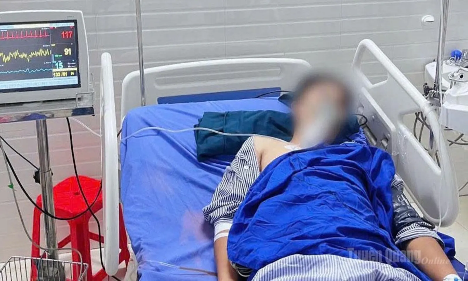 Cứu sống nam thanh niên 25 tuổi vỡ lách độ IV sau tai nạn xe máy ở Tuyên Quang