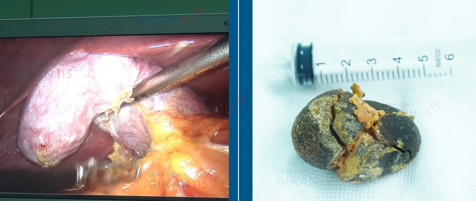 Sỏi túi mật chiếm gần hết lòng túi mật, khiến túi mật giãn to