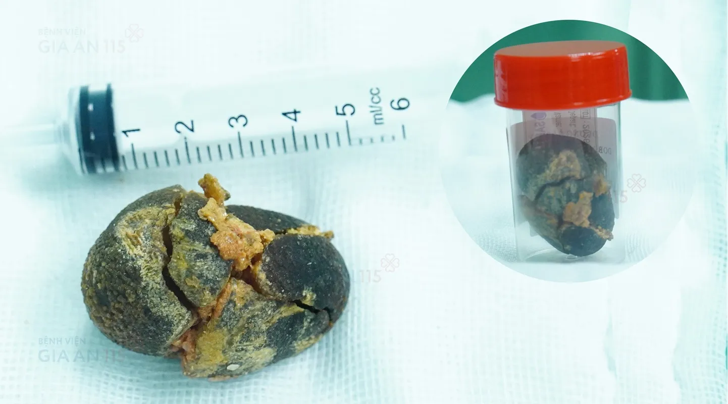 Sỏi túi mật được lấy ra khỏi người bệnh