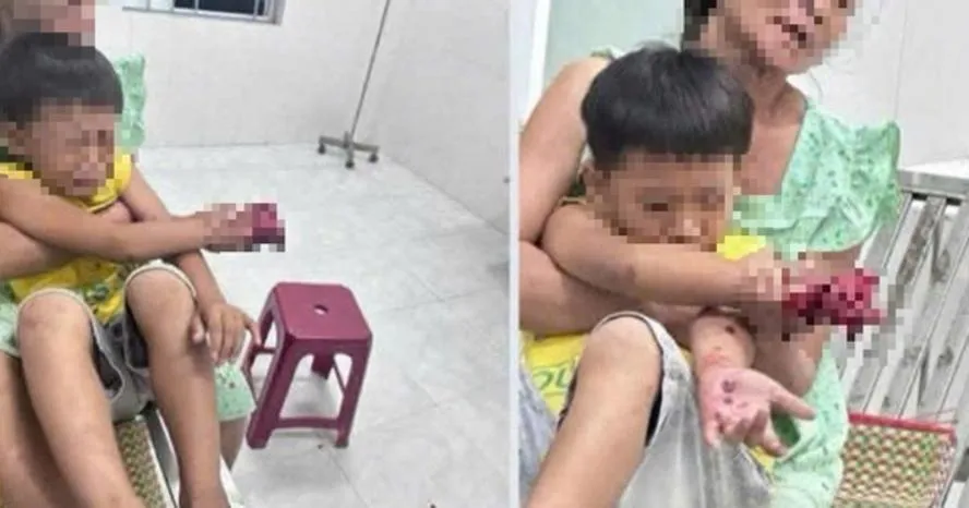 Cháu bé bị dập bàn tay nghi do điện thoại nổ lúc sạc pin