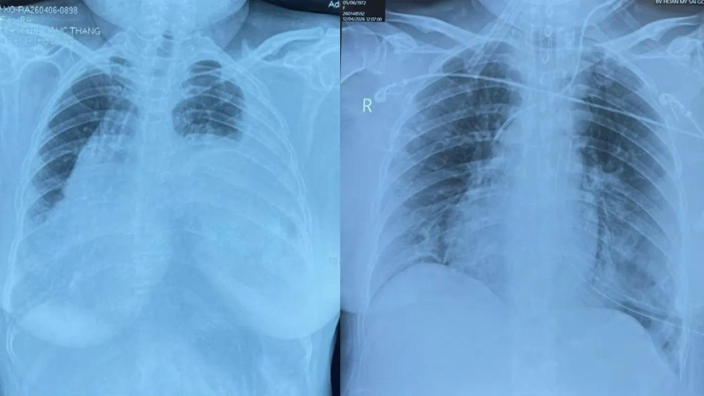 Hình ảnh phổi trước & sau điều trị