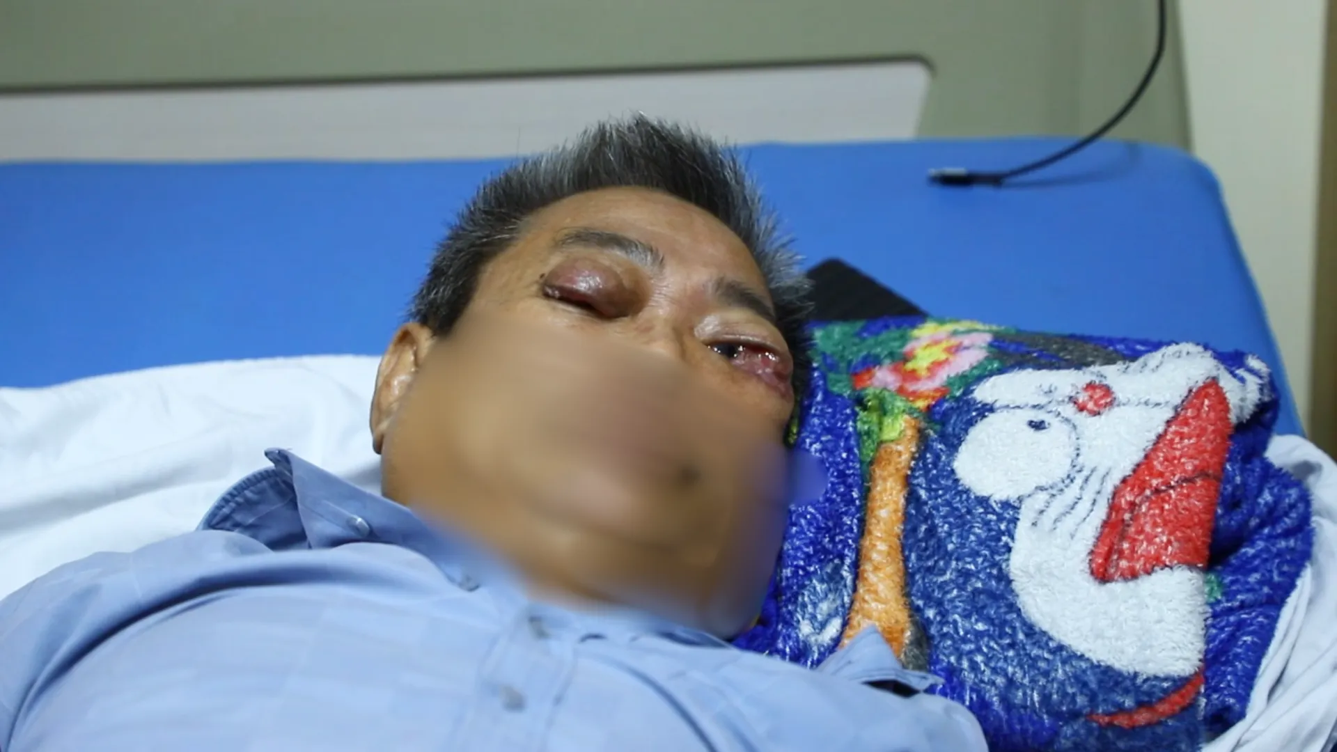 HAI MẮT BỆNH NHÂN SƯNG TO VÀ VIÊM TRƯỚC KHI ĐIỀU TRỊ