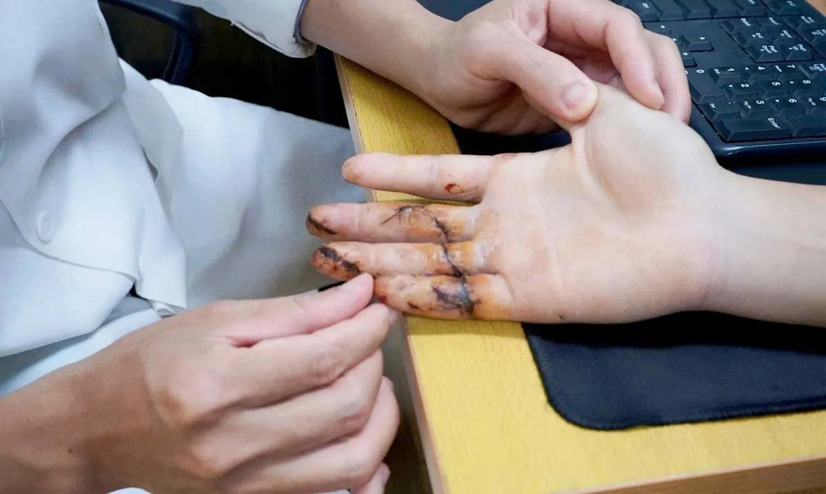 Vết cắt nhỏ, nguy cơ mất cả bàn tay