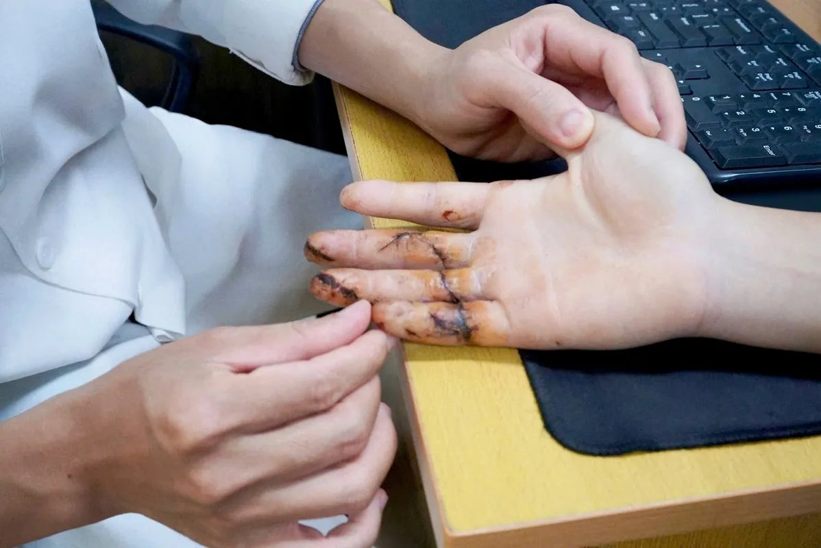 Vết cắt nhỏ nguy cơ mất cả bàn tay