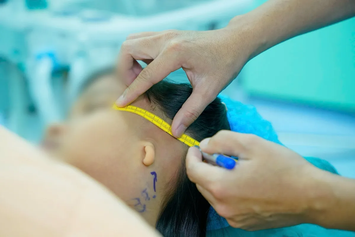 Người bệnh được đo đạc, đánh giá cấu trúc vùng tai trước phẫu thuật tạo hình tai nhỏ