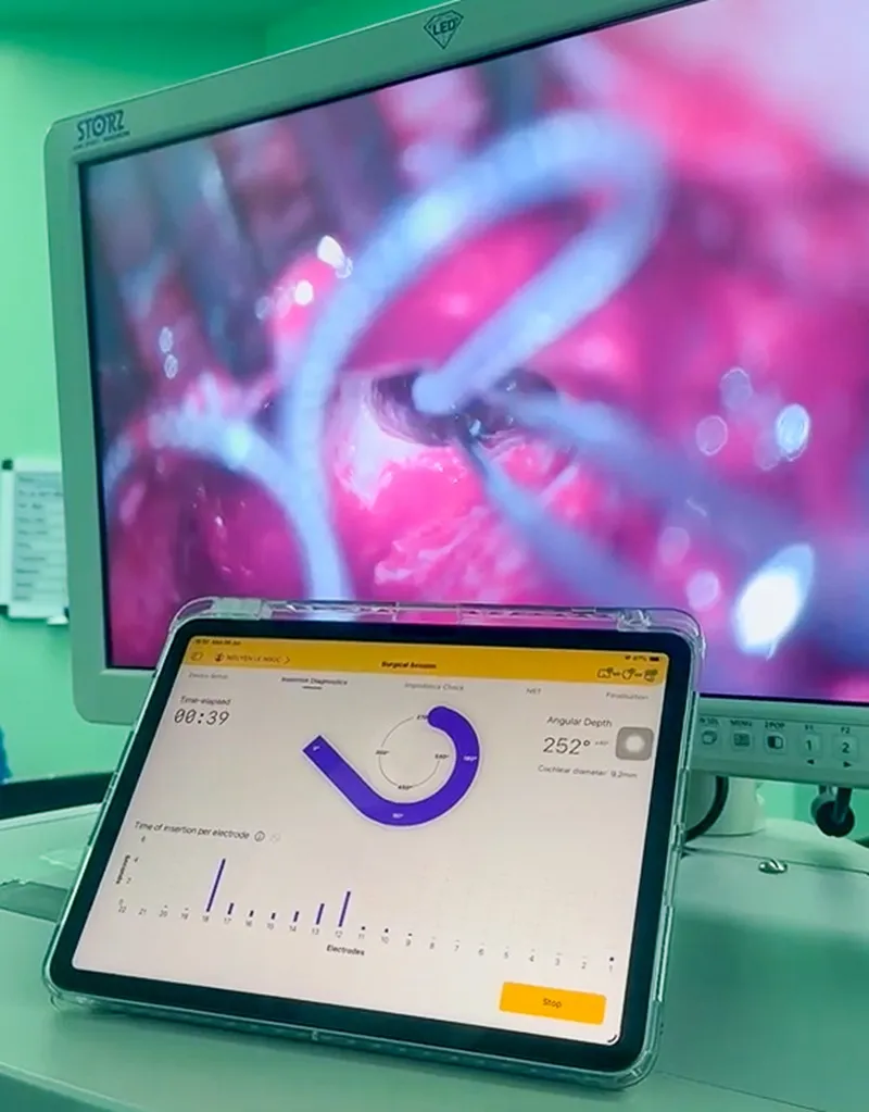 Hình ảnh điện cực đang được đặt vào ốc tai, với sợ hỗ trợ của các thiết bị hiện đại giúp đánh giá quá trình luồn điện cực như tốc độ