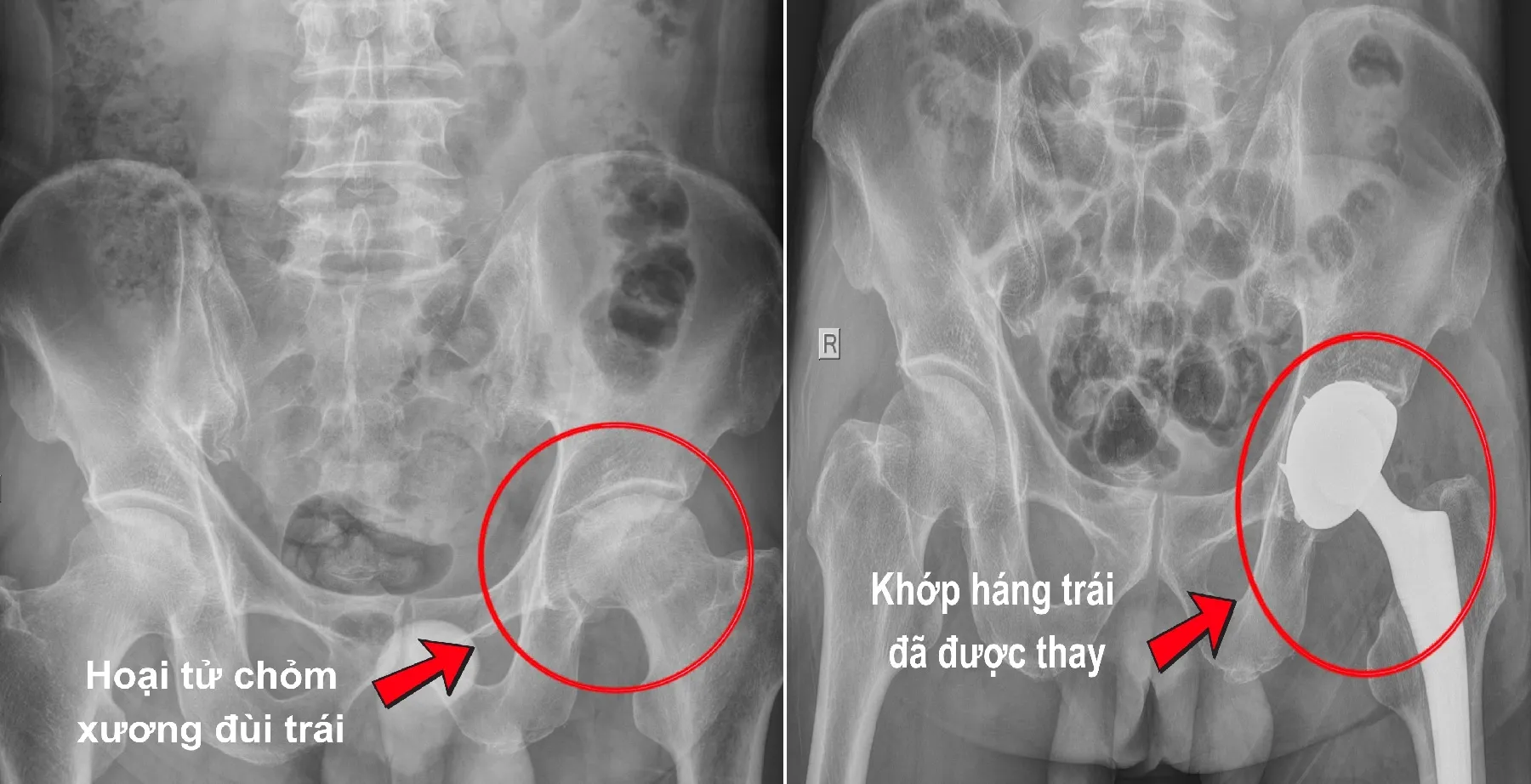 Hình ảnh khớp háng trước và sau phẫu thuật