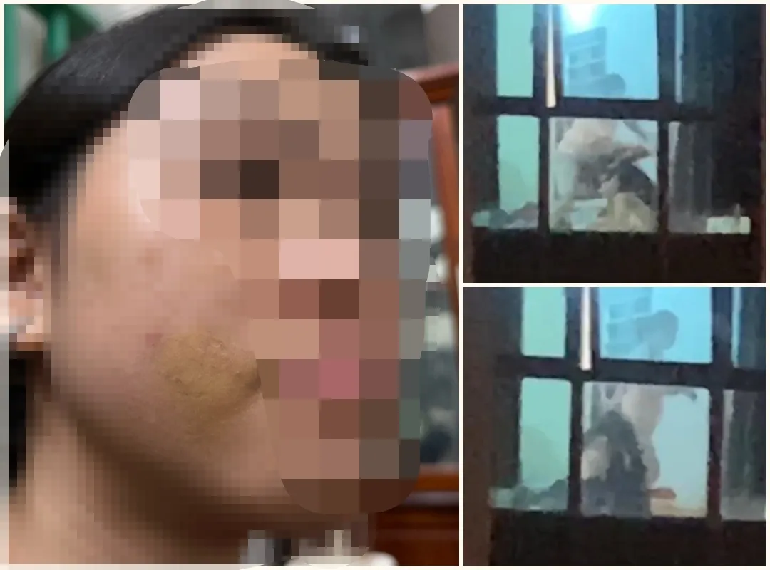 Bé gái bị mẹ kế bạo hành, bị bầm tím trên mặt