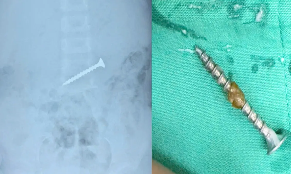 Bé gái 30 tháng tuổi nuốt đinh vít dài 3cm trong lúc chơi