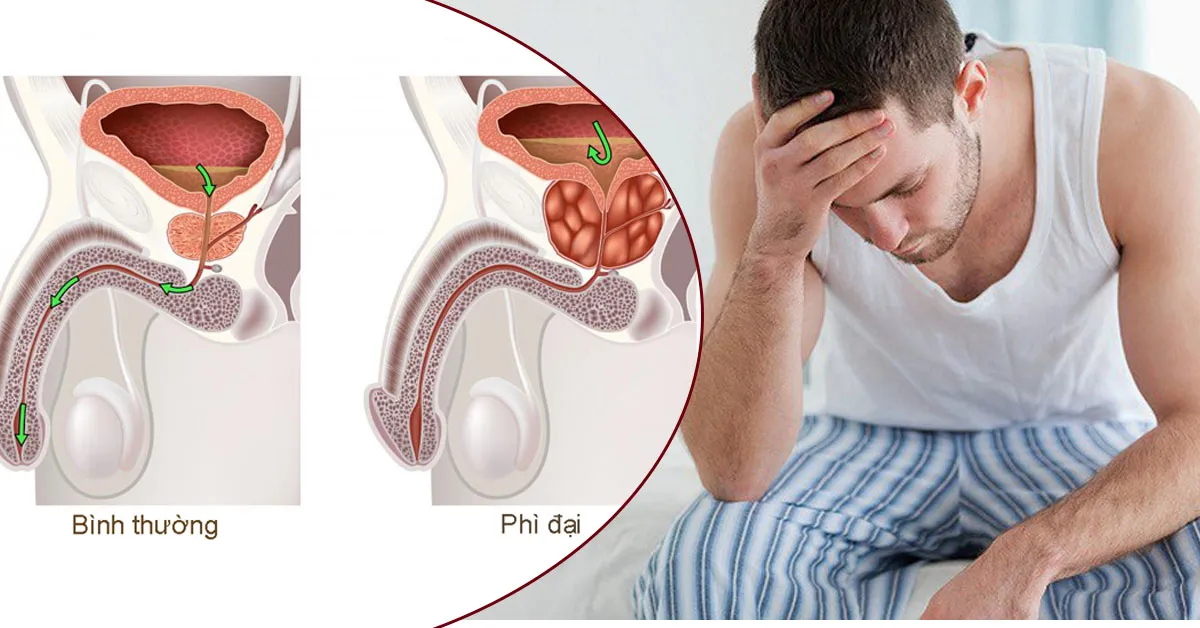 Phì đại tuyến tiền liệt thường gặp ở đối tượng nào ? Có điều trị được không?